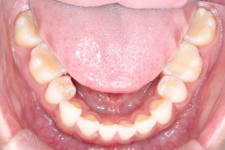 口ゴボをワイヤーによる抜歯矯正ですっきりとした口元へ 治療後画像