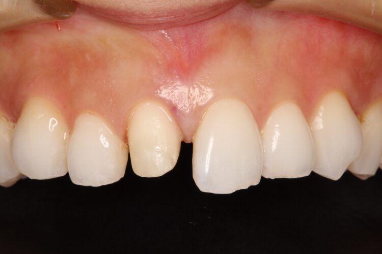前歯の色を自然にしたい 治療途中画像