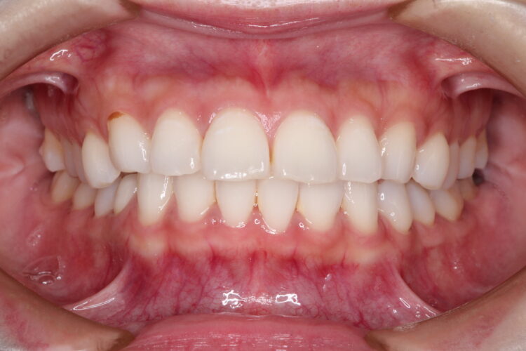 口ゴボをワイヤーによる抜歯矯正ですっきりとした口元へ 治療前画像