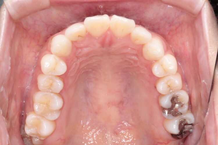 口ゴボをワイヤーによる抜歯矯正ですっきりとした口元へ 治療前画像