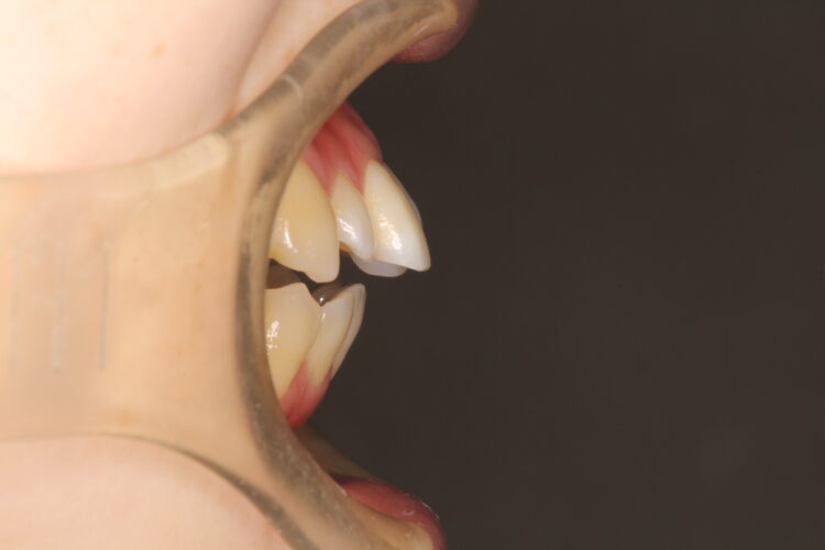 前歯で咬めない　ワイヤーでの抜歯矯正 治療前画像