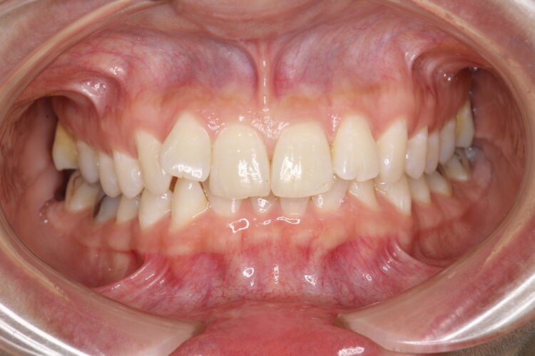飛び出た前歯のインビザラインによる目立たない矯正 治療前画像