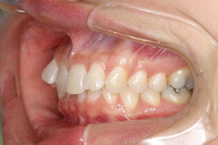 飛び出た前歯のインビザラインによる目立たない矯正 治療前画像