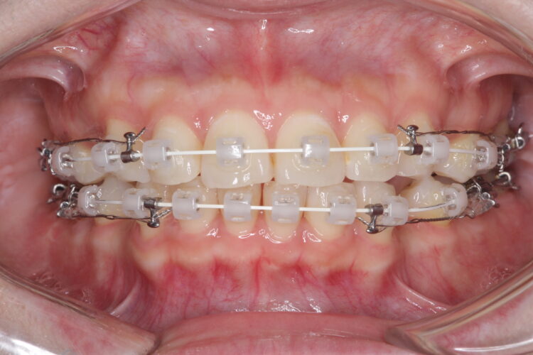 口ゴボをワイヤーによる抜歯矯正ですっきりとした口元へ 治療途中画像