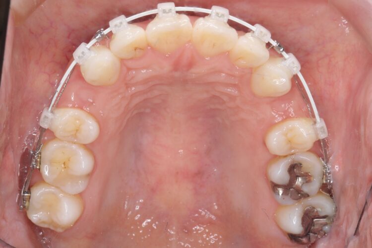 口ゴボをワイヤーによる抜歯矯正ですっきりとした口元へ 治療途中画像