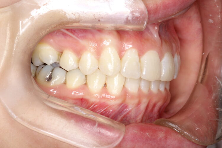 飛び出た前歯のインビザラインによる目立たない矯正 治療後画像