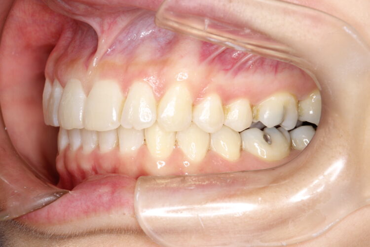 飛び出た前歯のインビザラインによる目立たない矯正 治療後画像