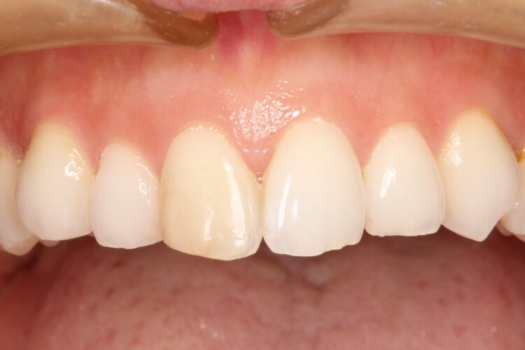 前歯の色を自然にしたい 治療前画像