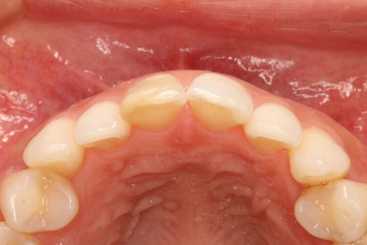 前歯の色を自然にしたい 治療前画像