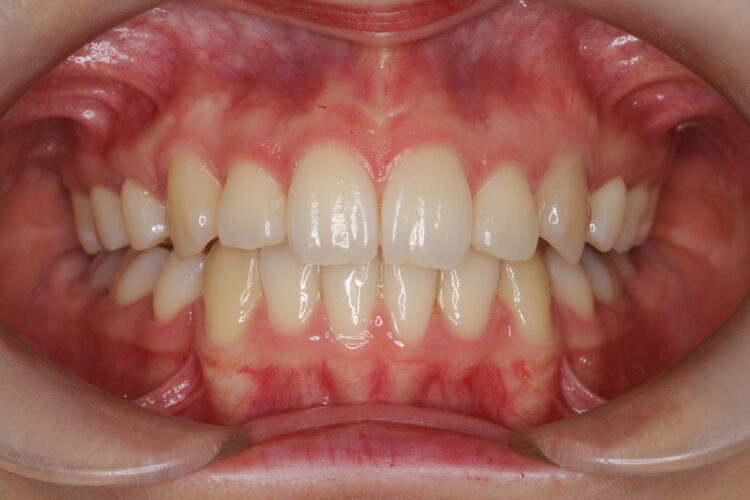 八重歯の矯正　ハーフリンガルによる目立たない抜歯矯正 治療後画像