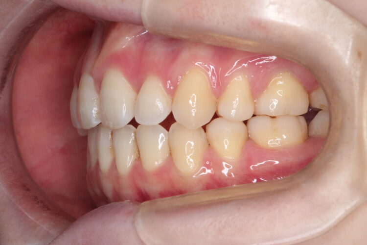 前歯で咬めない　ワイヤーでの抜歯矯正 治療後画像