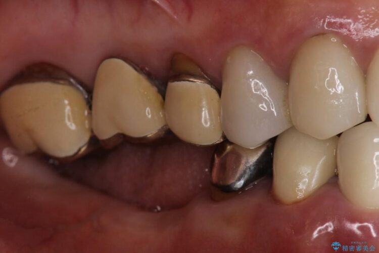 歯がない部分にインプラントとセラミックブリッジによる治療 治療前画像