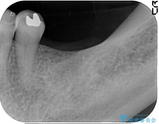 歯がない部分にインプラントとセラミックブリッジによる治療 治療前画像