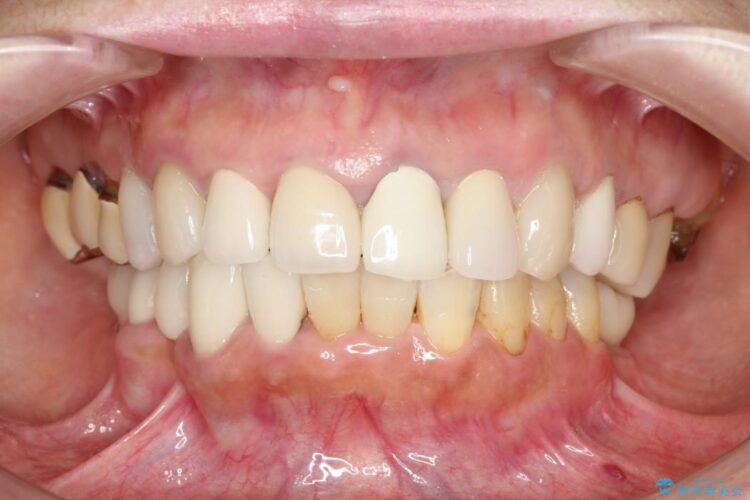 歯がない部分にインプラントとセラミックブリッジによる治療 治療後画像