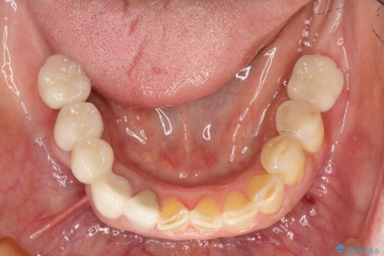 歯がない部分にインプラントとセラミックブリッジによる治療 治療後画像