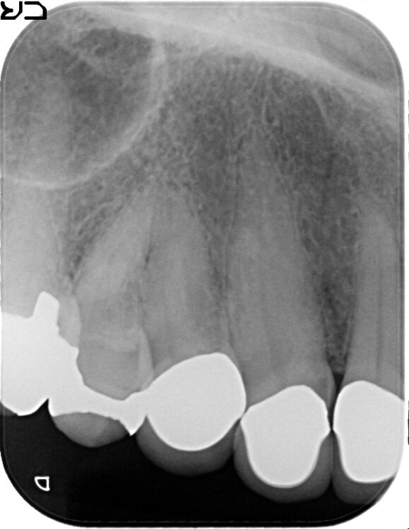 歯の根元が黒いのが気になる　セラミック治療 治療前画像