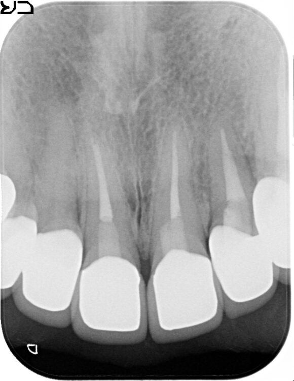 歯の根元が黒いのが気になる　セラミック治療 治療後画像