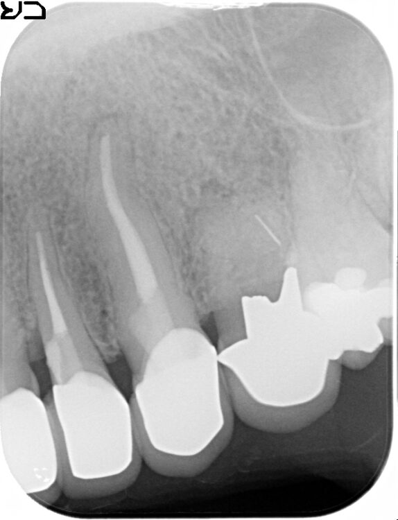 歯の根元が黒いのが気になる　セラミック治療 治療後画像
