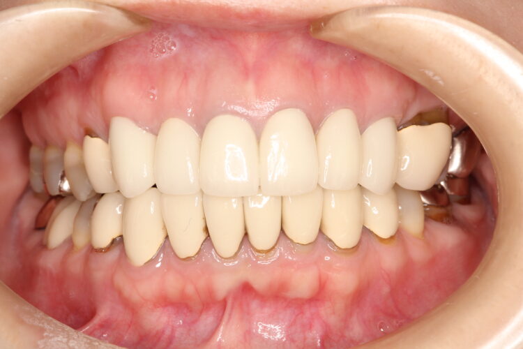 歯の根元が黒いのが気になる　セラミック治療 アフター