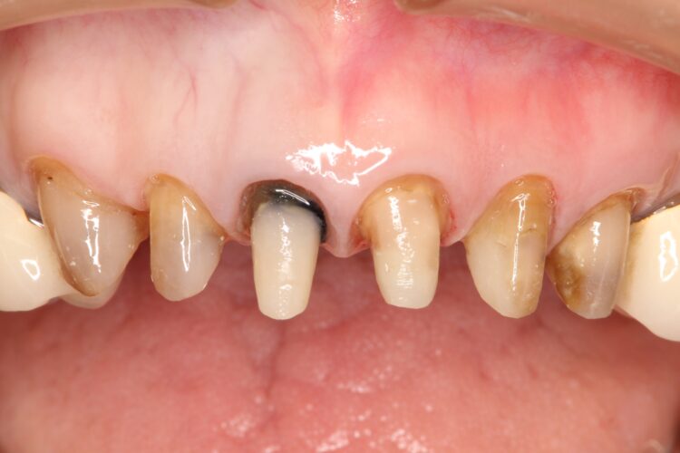 歯の根元が黒いのが気になる　セラミック治療 治療途中画像