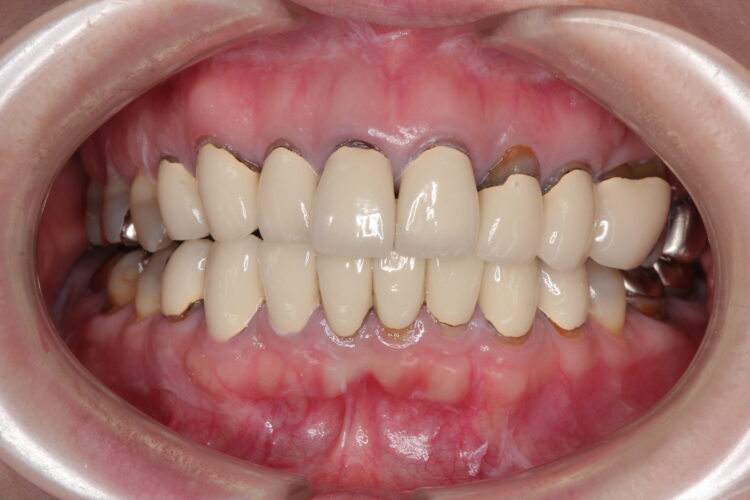 歯の根元が黒いのが気になる　セラミック治療 ビフォー