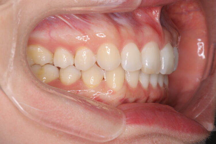 歯と歯の間の隙間をインビザラインで目立たたずストレスなく矯正 治療後画像