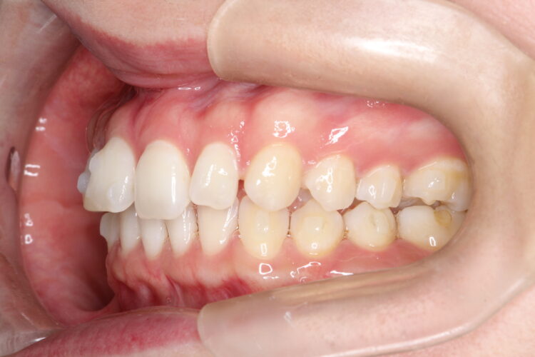 歯と歯の間の隙間をインビザラインで目立たたずストレスなく矯正 治療途中画像