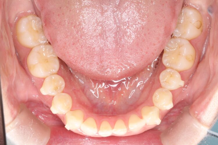 歯と歯の間の隙間をインビザラインで目立たたずストレスなく矯正 治療途中画像