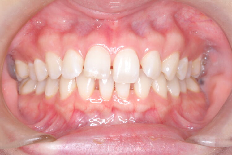 歯と歯の間の隙間をインビザラインで目立たたずストレスなく矯正 治療前画像