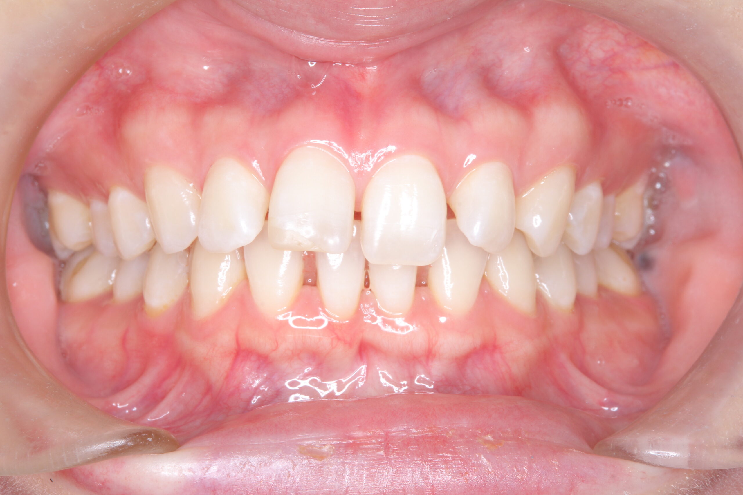 歯と歯の間の隙間をインビザラインで目立たたずストレスなく矯正 治療前