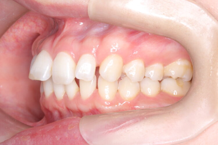 歯と歯の間の隙間をインビザラインで目立たたずストレスなく矯正 治療前画像