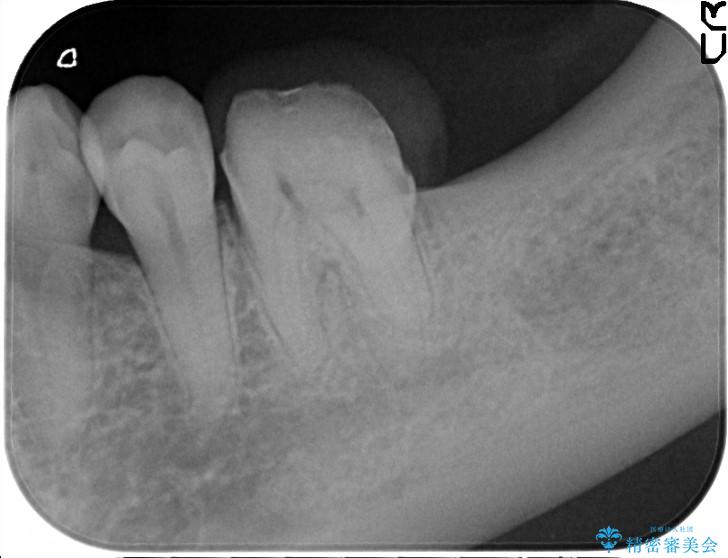 失った歯をインプラントで咬合回復 治療前画像