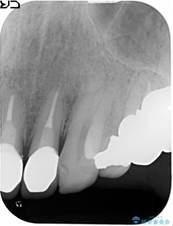 上の前歯の根元が黒い　根の治療を含めたセラミック再治療 治療後画像