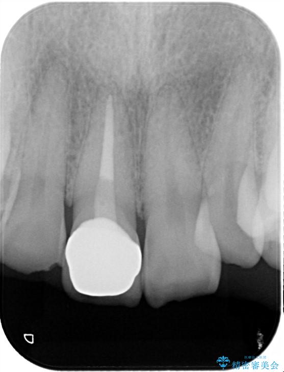 セラミックによる前歯の変色の改善 治療後画像