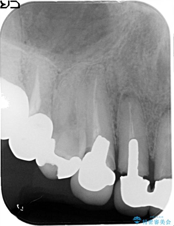 上の前歯の根元が黒い　根の治療を含めたセラミック再治療 治療前画像