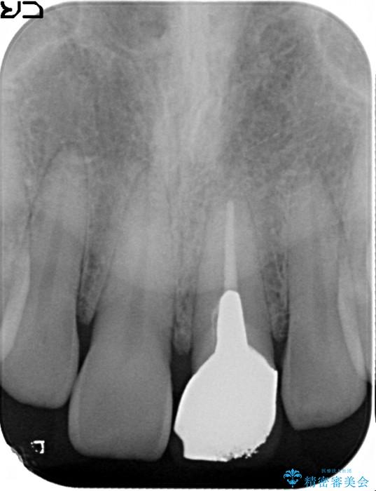 前歯が折れていた　インプラントによる審美的・機能的回復 治療前画像