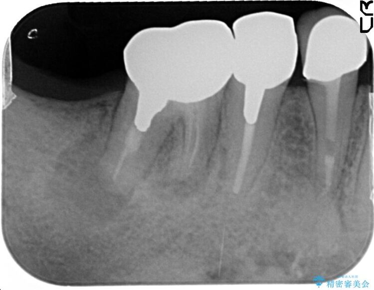 歯がなくなってしまったところをインプラントで奥歯でも噛めるように 治療前画像