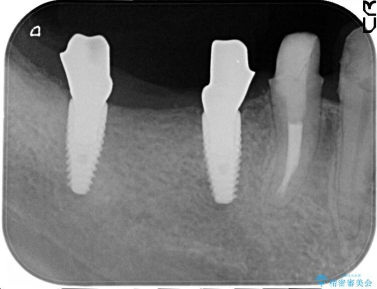 失った奥歯　インプラントブリッジで咬合回復 治療途中画像