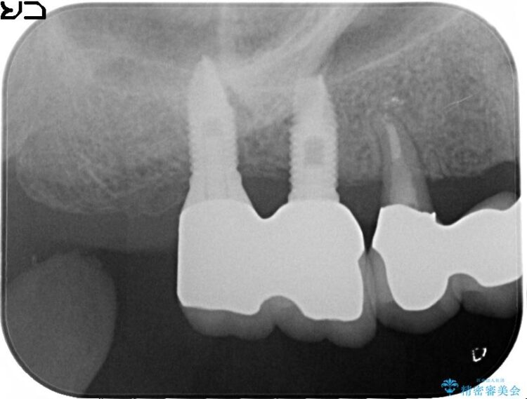 奥歯で咬むことができない　インプラントとセラミックによる咬み合わせの回復 治療後画像