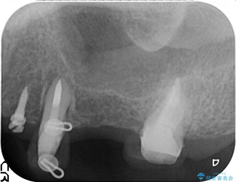 部分矯正で歯を正しい位置に移動しインプラント治療を行った症例 治療途中画像