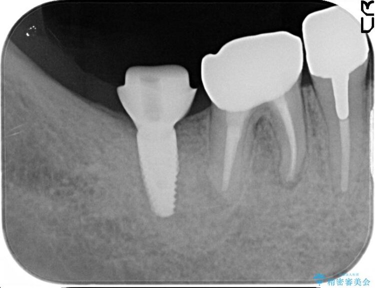 歯がなくなってしまったところをインプラントで奥歯でも噛めるように 治療途中画像