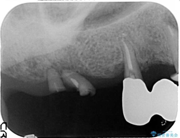 奥歯で咬むことができない　インプラントとセラミックによる咬み合わせの回復 治療前画像