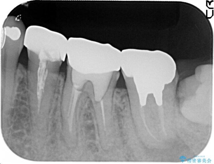 根管治療とインプラント治療で奥歯でしっかりと咬めるように 治療前画像