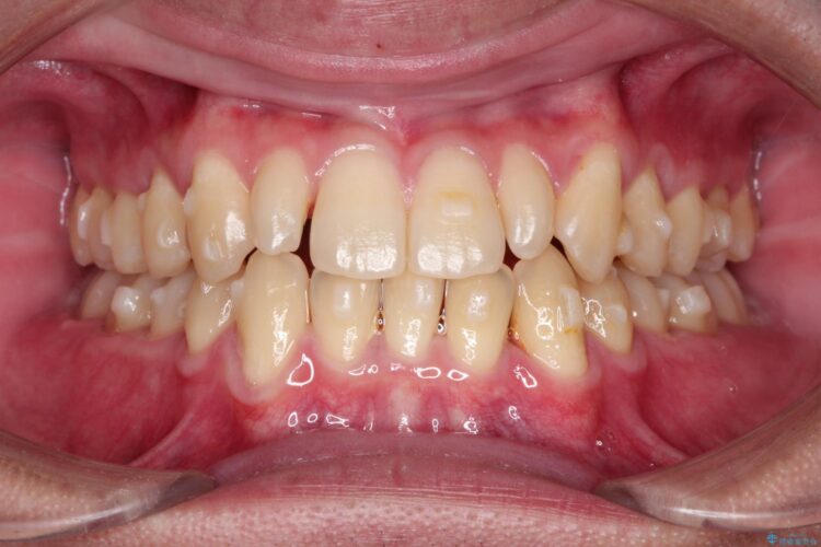 矮小歯(通常より小さな歯)をオールセラミックへ　自然な見た目に 治療前画像