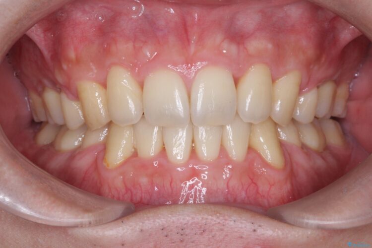 前歯のガタガタをきれいにしたい　ワイヤーによる抜歯矯正で整った歯並びへ アフター