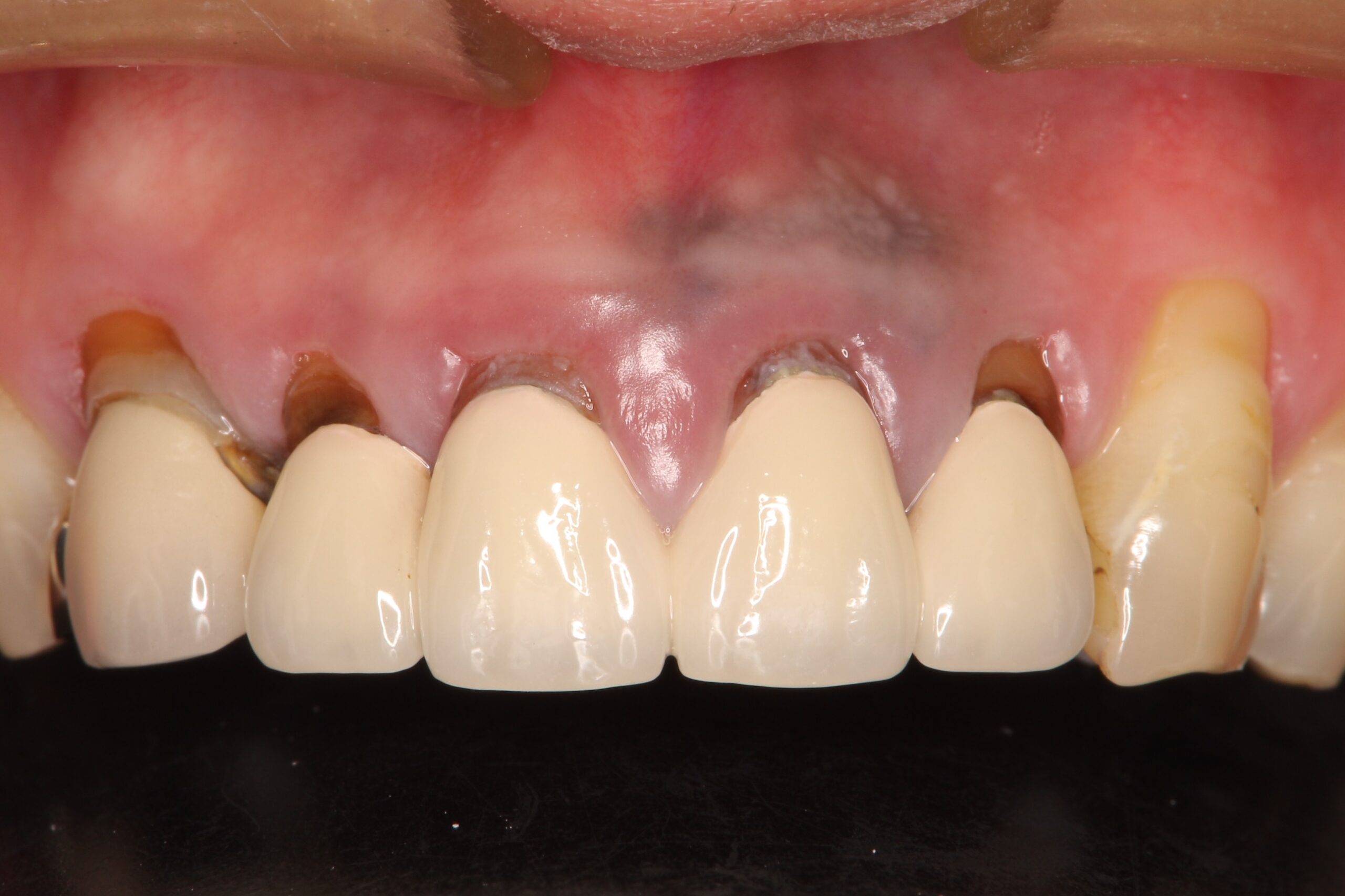 上の前歯の根元が黒い　根の治療をしてからセラミックの再治療 治療前