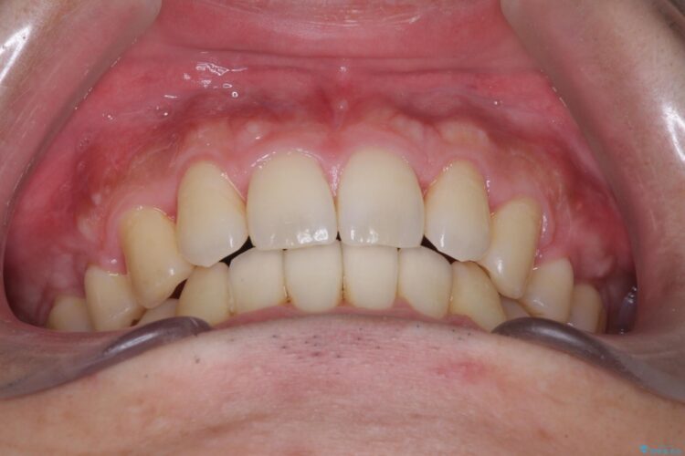 前歯のガタガタをきれいにしたい　ワイヤーによる抜歯矯正で整った歯並びへ 治療後画像