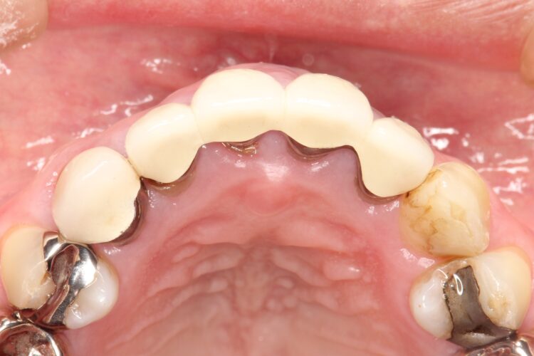 上の前歯の根元が黒い　根の治療をしてからセラミックの再治療 治療前画像