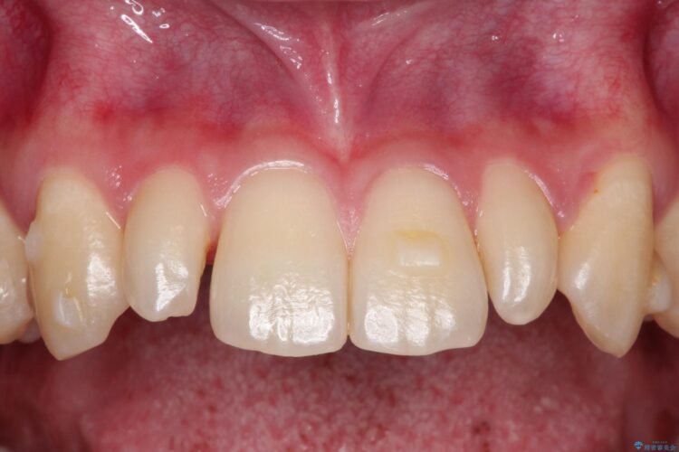 矮小歯(通常より小さな歯)をオールセラミックへ　自然な見た目に 治療前画像