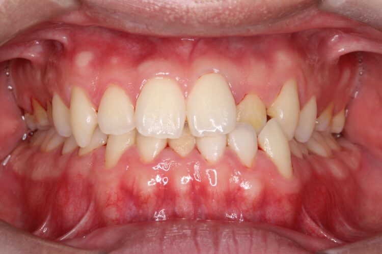 オフィスホワイトニングで明るく白い歯に！ 治療前画像